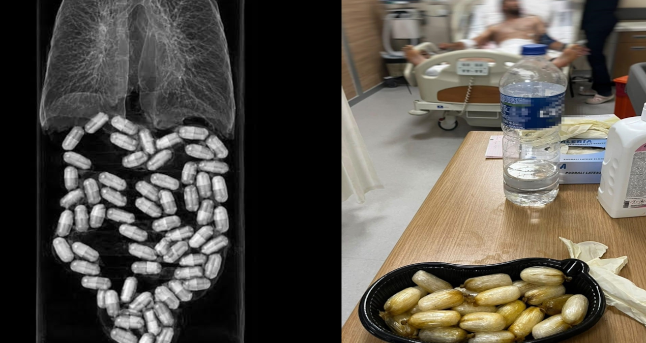 Midesinden 590 gram uyuşturucu çıktı Haber gorseli